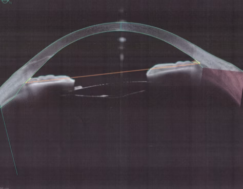 Aspect Tomografic Postoperator Cu Deschiderea Unghiului Si Remiterea Simptomatologiei Glaucomatoase