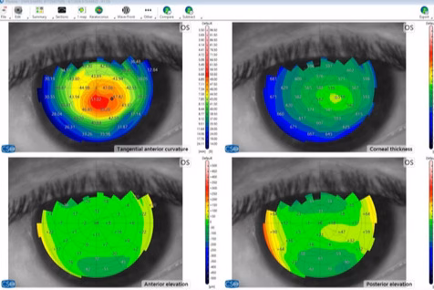 Dupa Crosslinking Corneea S A Stabilizat Inclusiv In Zona De Subtiere Maxima