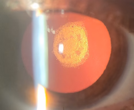 Miopie Si Astigmatism
